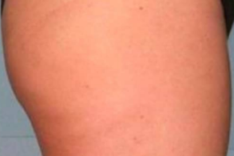 gambe dopo